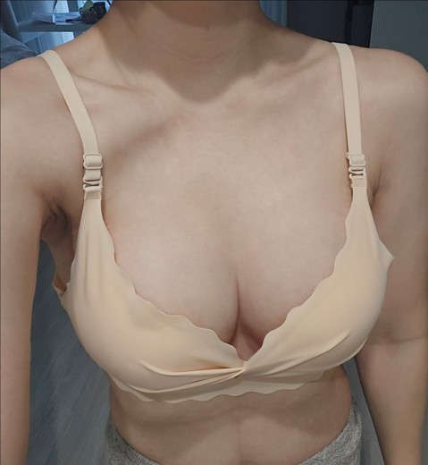 after photo: 가슴(보형물)