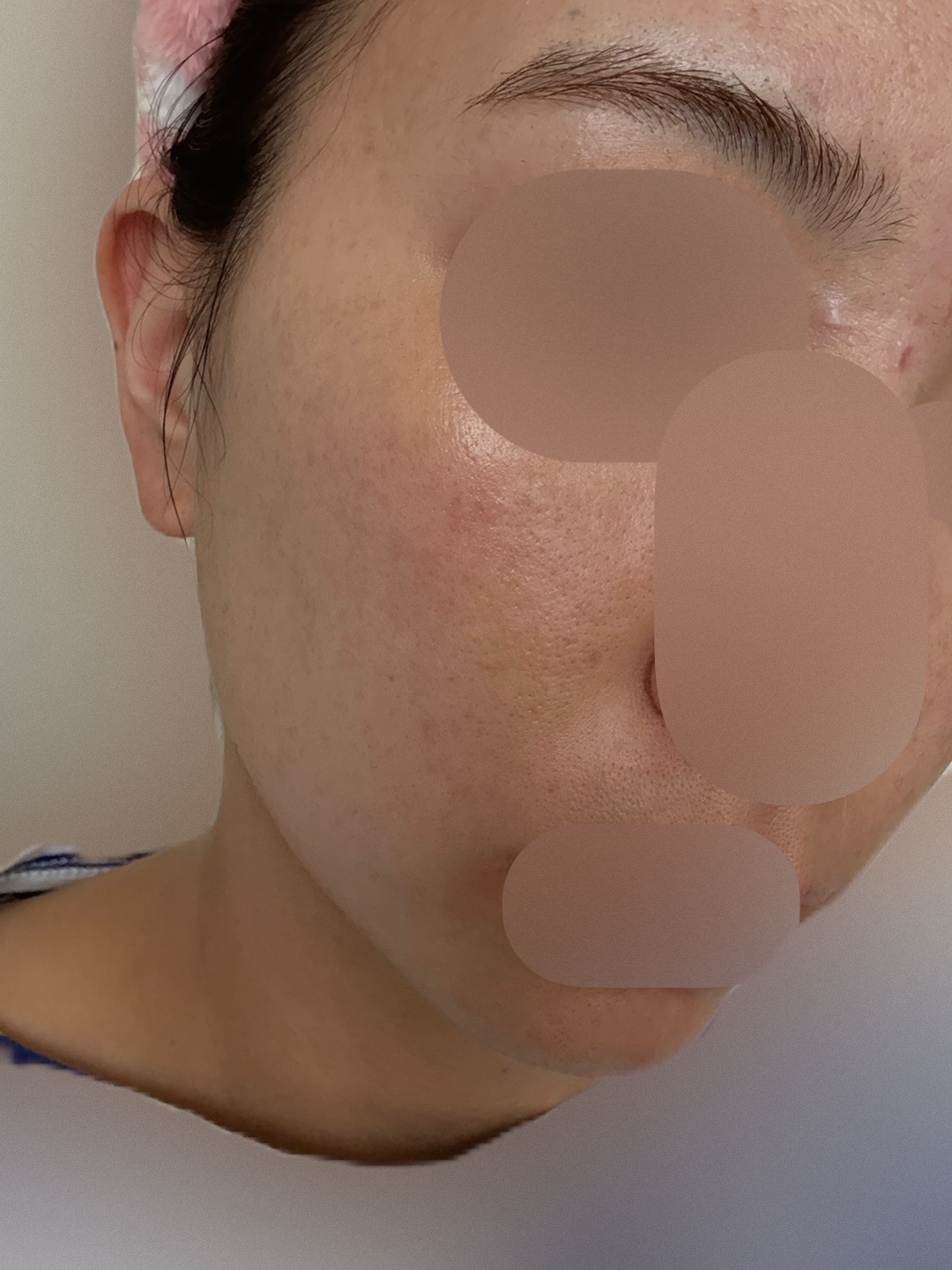 IPL（光治療）全顔2周 ｜ステラM22フォトフェイシャル【11月15日迄にご