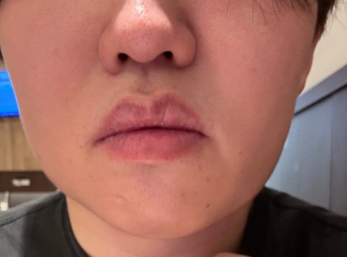 after photo: 脂肪溶解注射(顔)