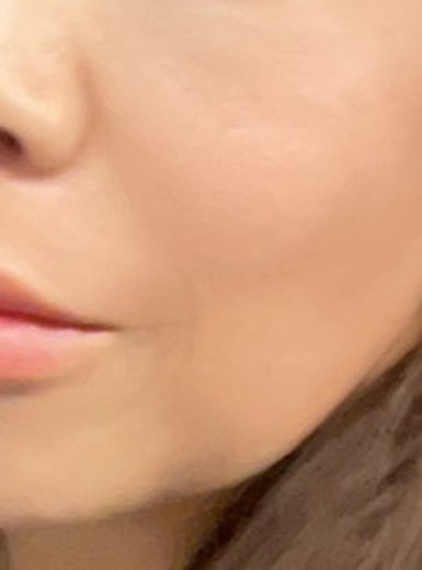after photo: 前頬骨ヒアルロン酸