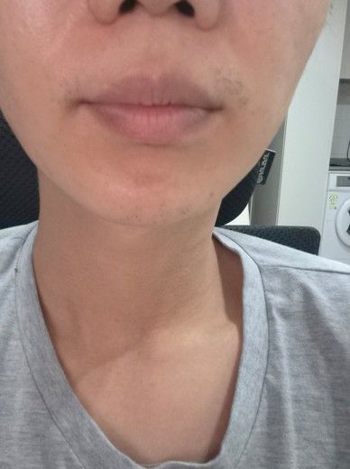 after photo: 턱제모, 인중제모