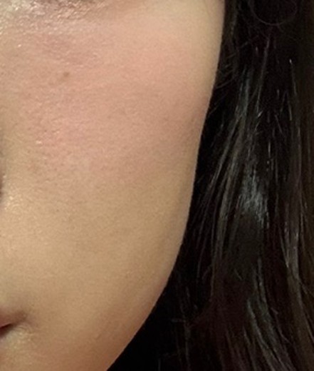 before photo: 옆볼필러