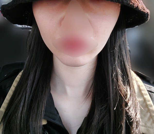 before photo: IPL(光/フォト治療)