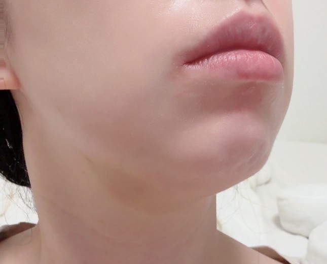 after photo: 脂肪溶解注射(顔)