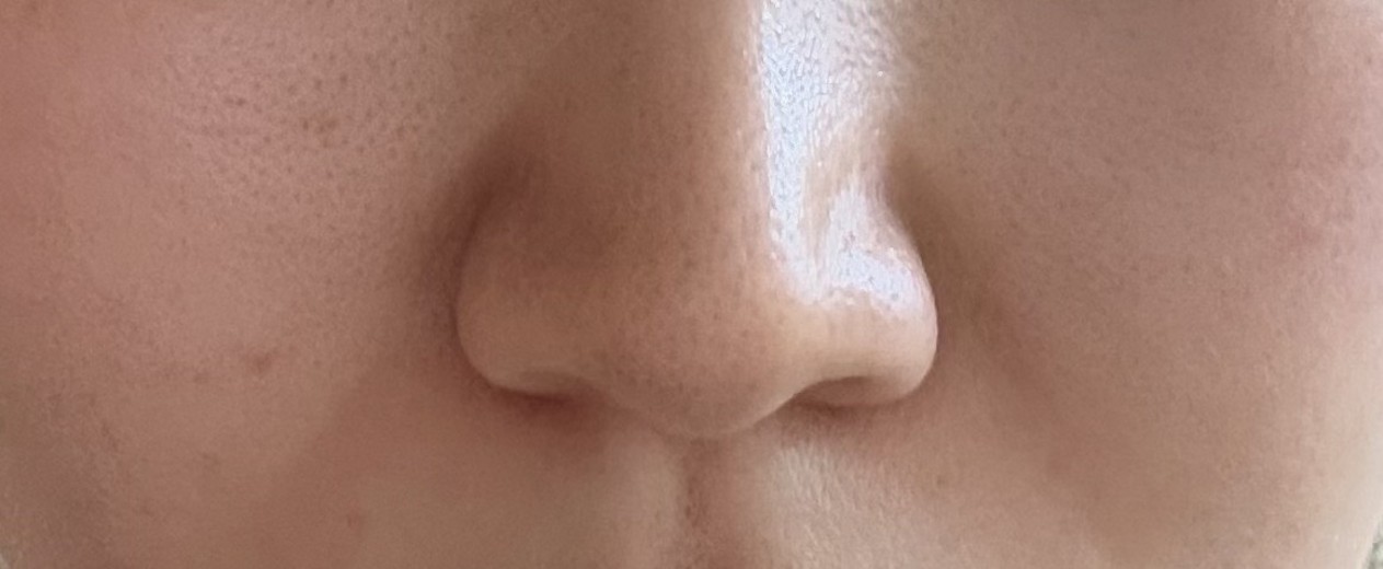 after photo: 脂肪溶解注射(顔)