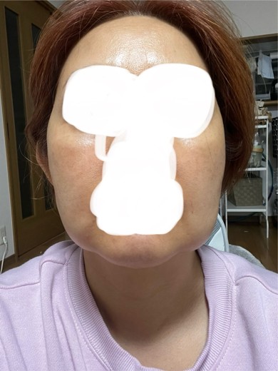 after photo: 脂肪溶解注射(顔)