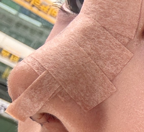 after photo: 콧대(보형물), 코끝(자가연골)