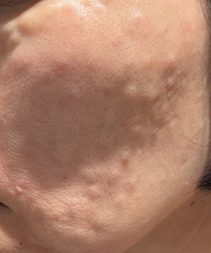 after photo: 리쥬란힐러