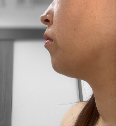 after photo: 脂肪溶解注射(腕), 脂肪溶解注射(顔)