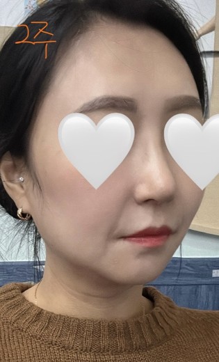 after photo: 콧대(보형물), 코끝(자가연골)