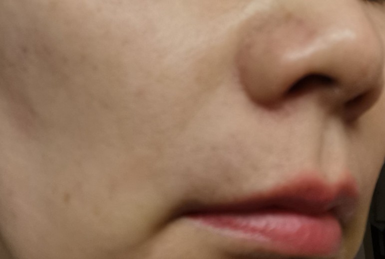 after photo: 脂肪溶解注射(顔)
