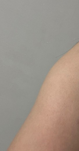 before photo: 팔지방분해주사