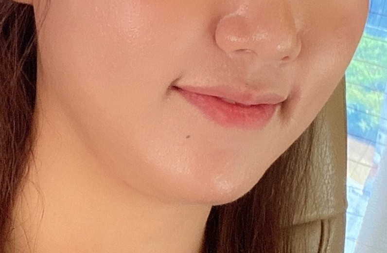 after photo: 슈링크리프팅