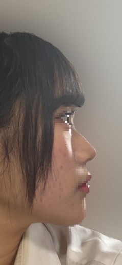 before photo: 脂肪吸引(腕)