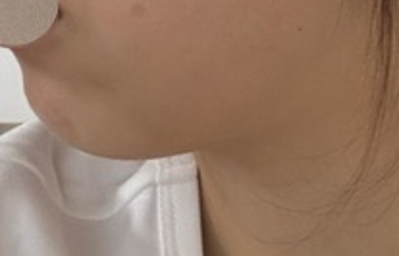 before photo: リニアファーム(ハイフ)