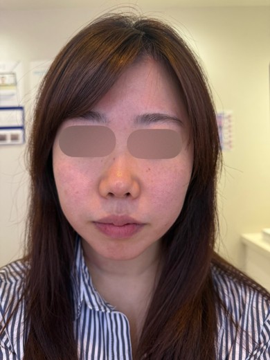 before photo: IPL(光/フォト治療), ルメッカ