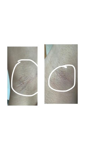 before photo: 겨드랑이제모