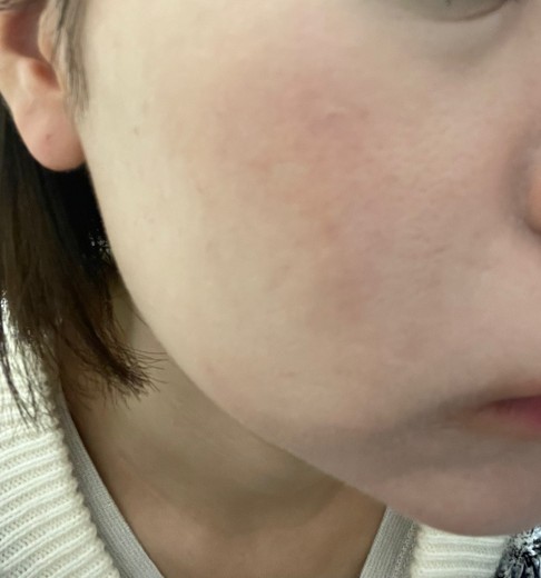 after photo: イオン導入