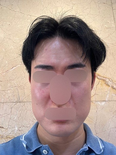 before photo: エレクトロポレーション