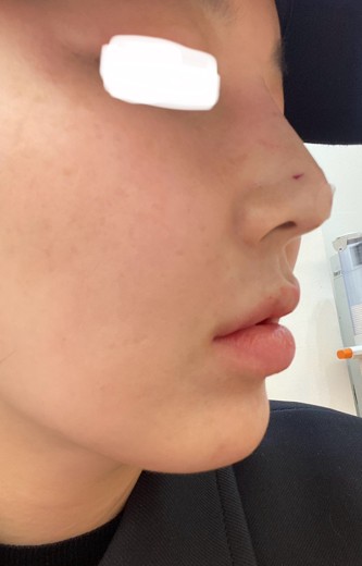 before photo: 앞광대필러