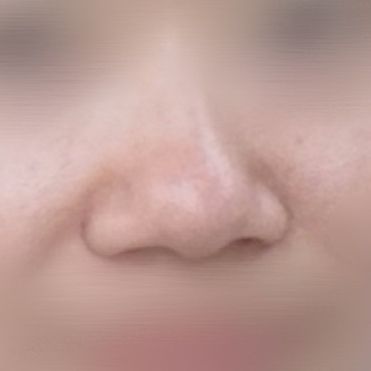 before photo: 콧볼축소, 복코교정(수술)