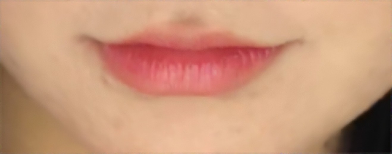 before photo: 입술필러