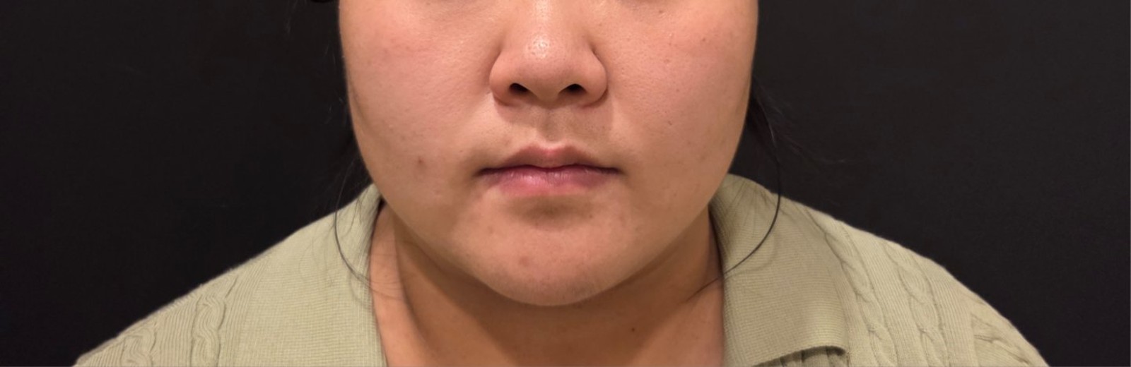 before photo: 비중격만곡증수술, 코끝(보형물)