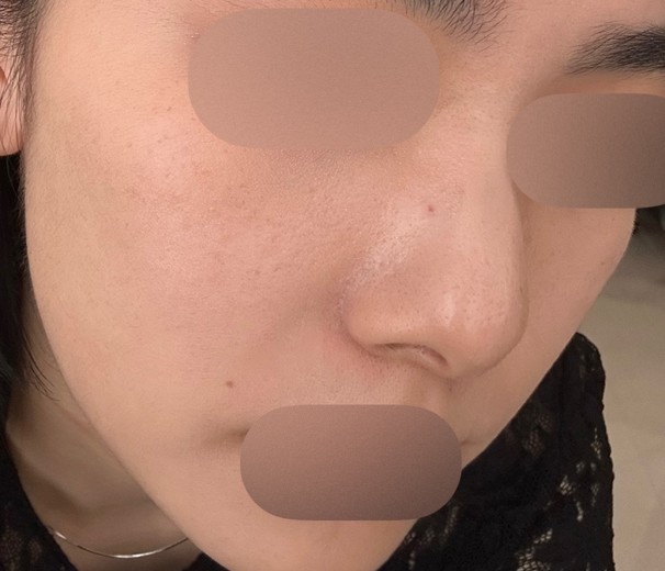 before photo: ルメッカ