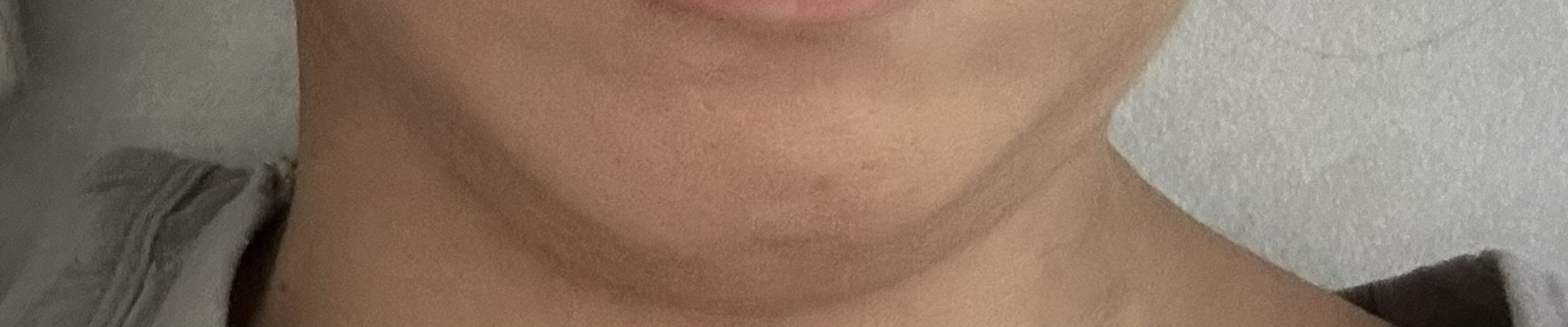 before photo: 브이올렛주사