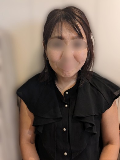 before photo: 脂肪溶解注射(顔)