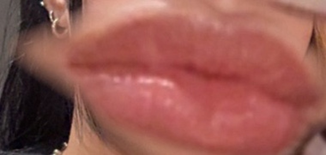 before photo: 필러제거주사