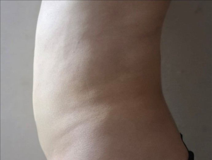 after photo: 복부지방흡입