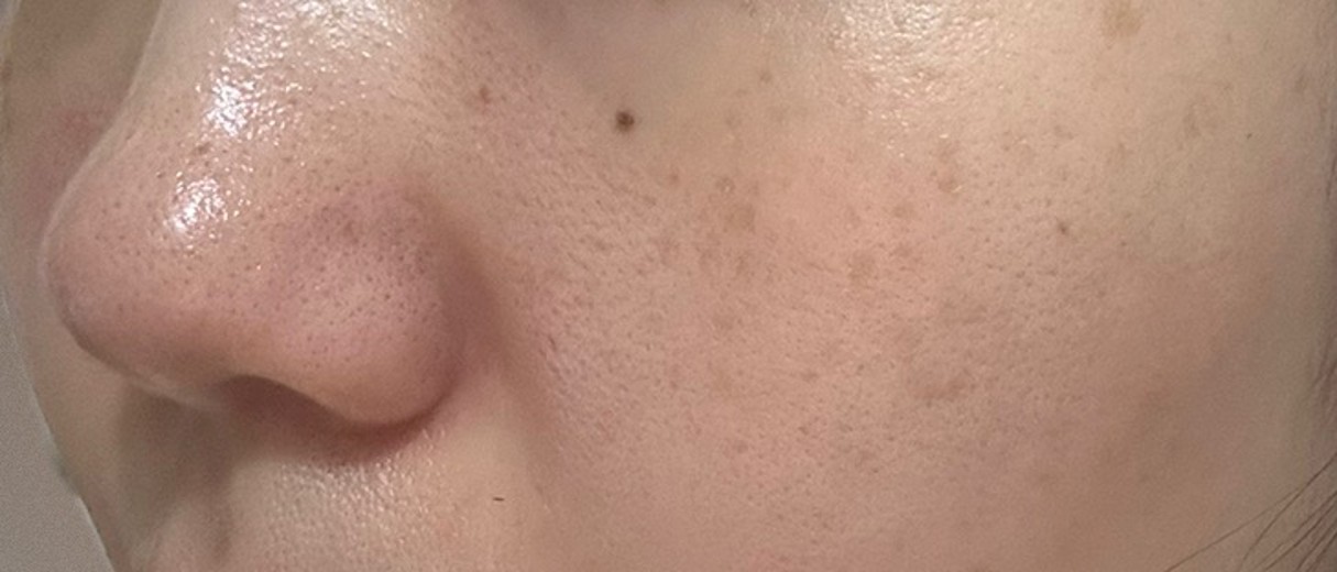 before photo: IPL(光/フォト治療), 診断・検査
