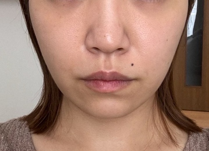 after photo: 糸リフト
