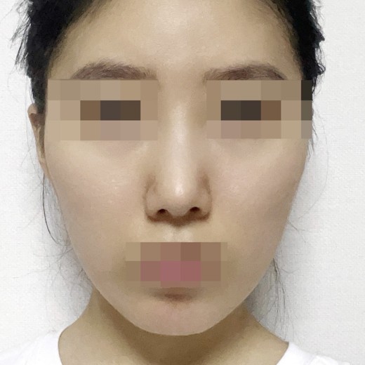 after photo: 코끝(자가연골)