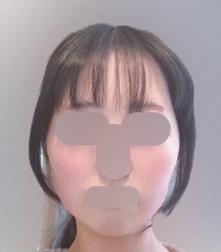 after photo: 脂肪溶解注射(腕), 脂肪溶解注射(顔)
