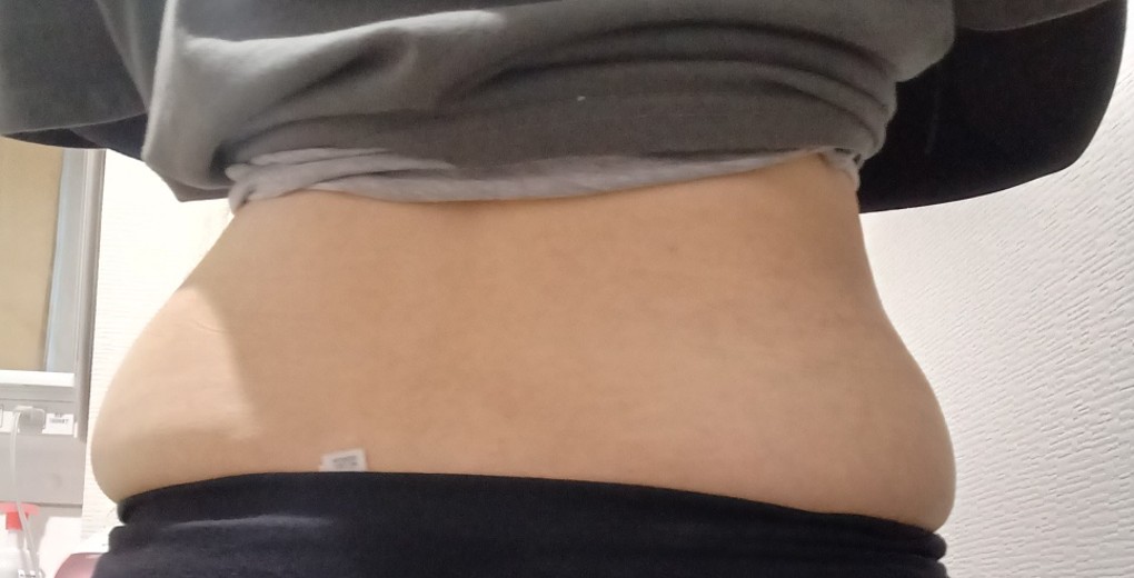 after photo: 高周波脂肪溶解(腹部)