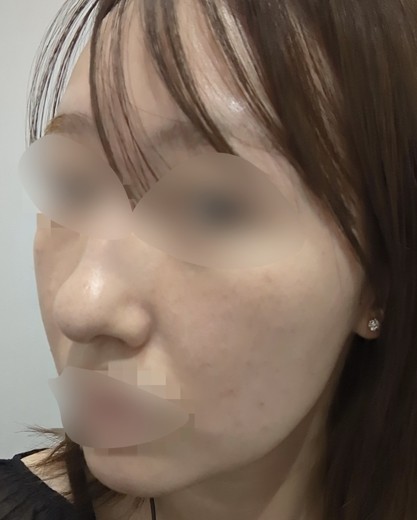 before photo: ルメッカ
