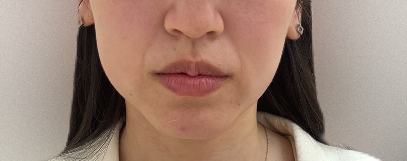 after photo: ハイフ(HIFU)