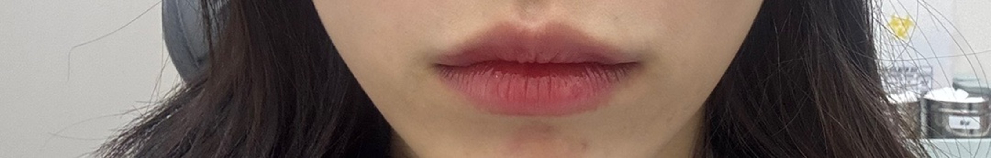 before photo: 입꼬리성형