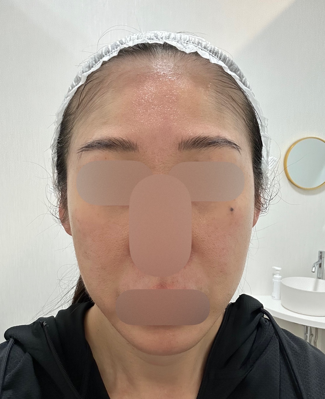 マッサージピール＋エレクトロポーション【再来OK】 | ライズワン美容