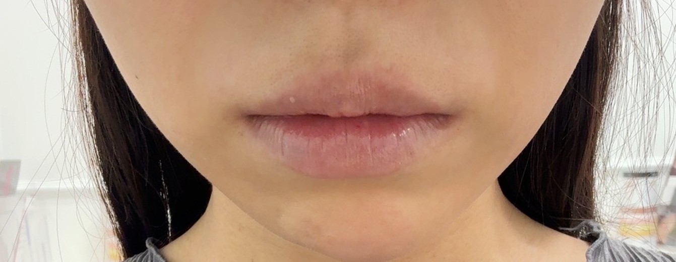 before photo: エラボトックス
