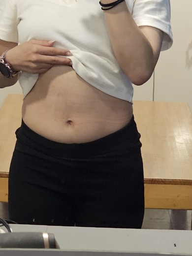 before photo: 복부지방분해주사