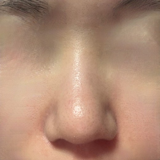 after photo: 콧볼축소, 복코교정(수술)