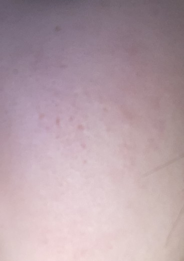 after photo: レーザートーニング, トラネキサム酸