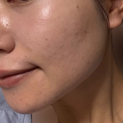 before photo: 水光注射, ジュベルック(Juvelook)
