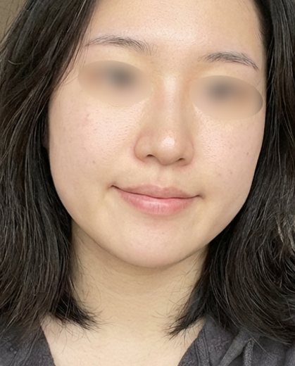 輪郭三点の施術・口コミ・クリニック情報(2026) | カンナムオンニ