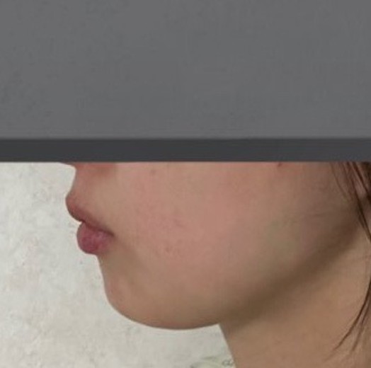 after photo: 唇ヒアルロン酸