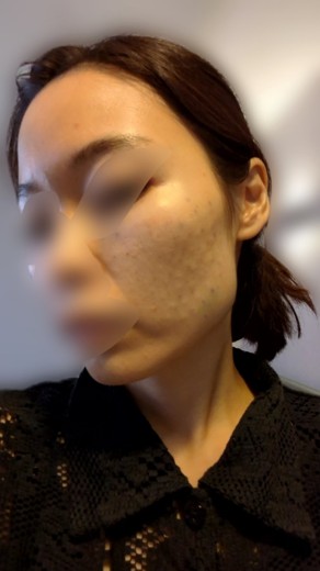 after photo: 脂肪溶解注射(腕), 脂肪溶解注射(太もも)
