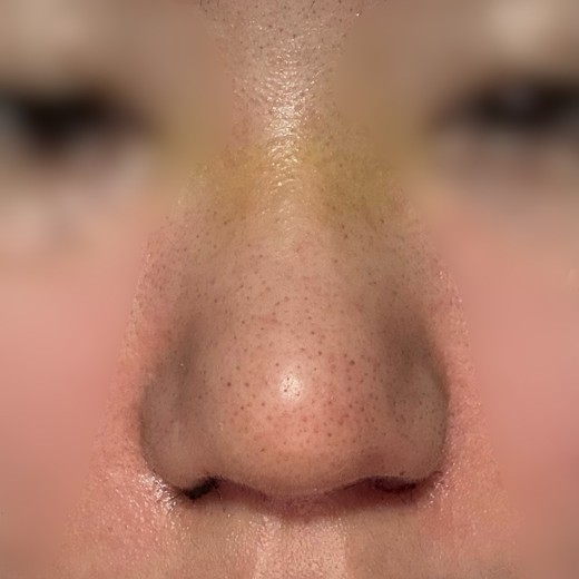 after photo: 콧볼축소, 복코교정(수술)